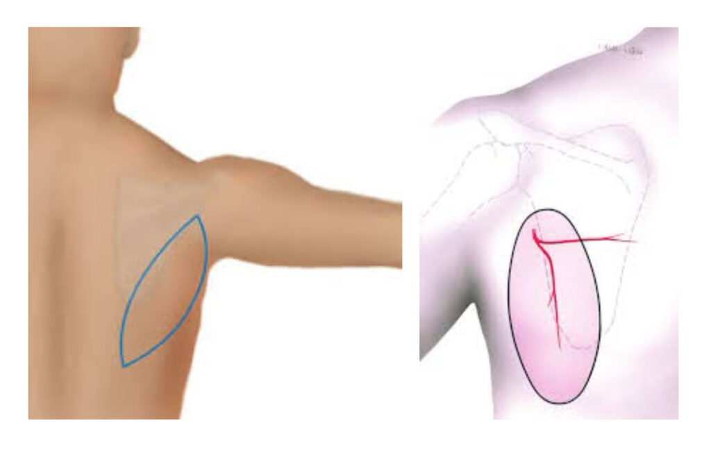 Free-Scapula-flap-Image-1