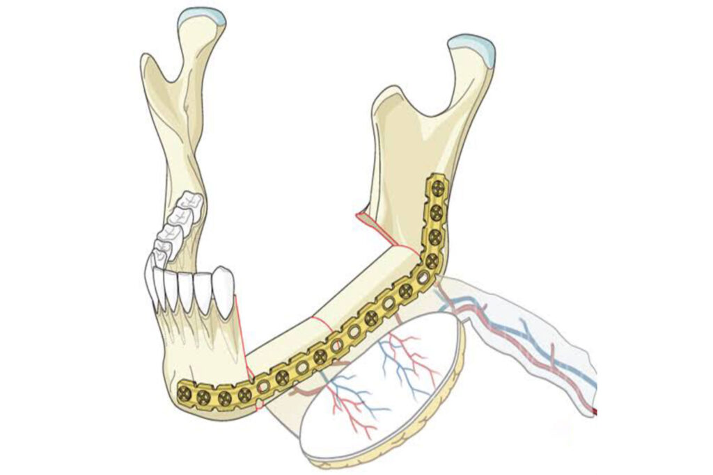 Free-Scapula-flap-Image-2 (1)