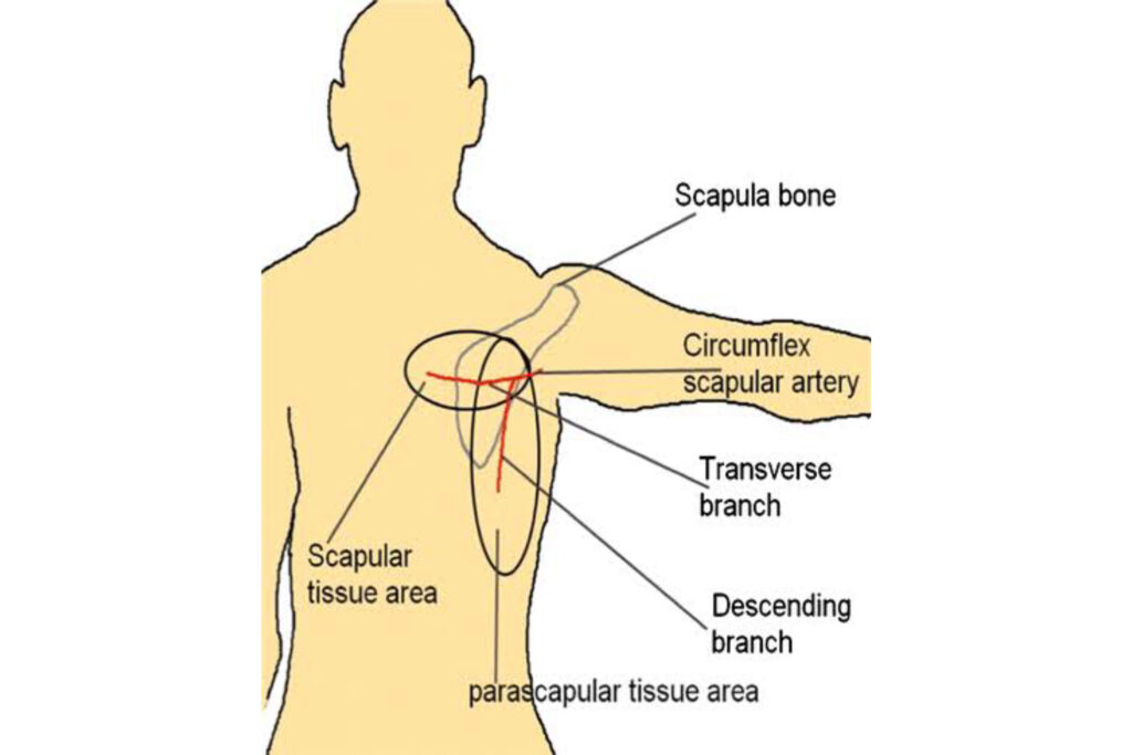Free-Scapula-flap-Image-3 (1)