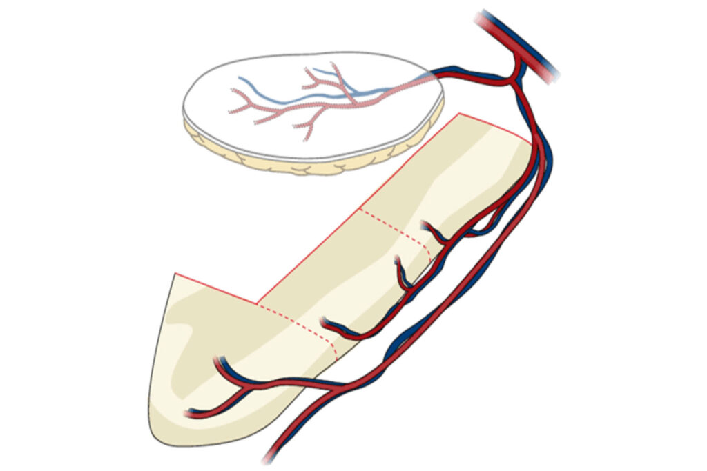 Free-Scapula-flap-Image-4 (1)