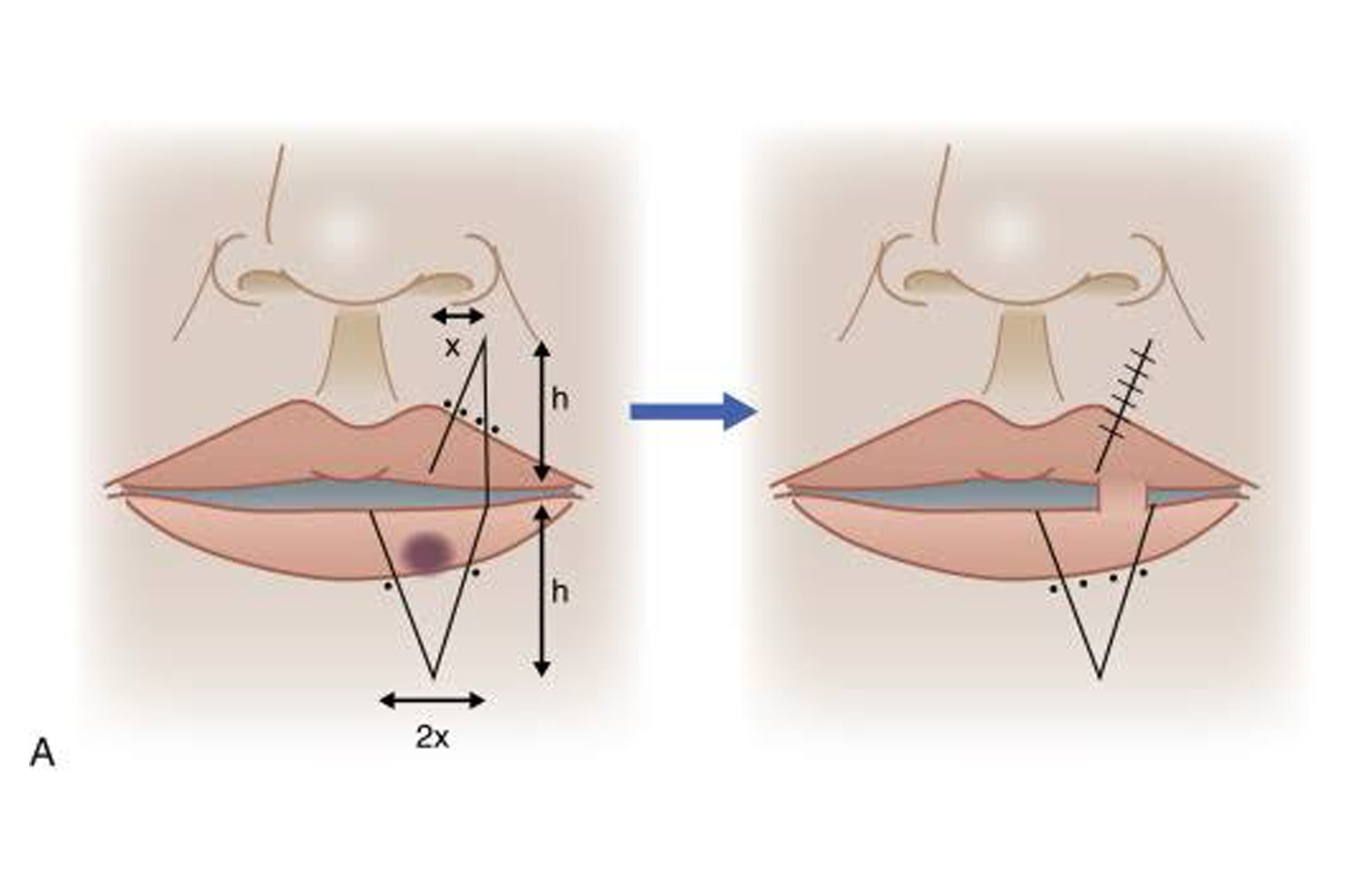 Cross-lip-flap-(Abbé)