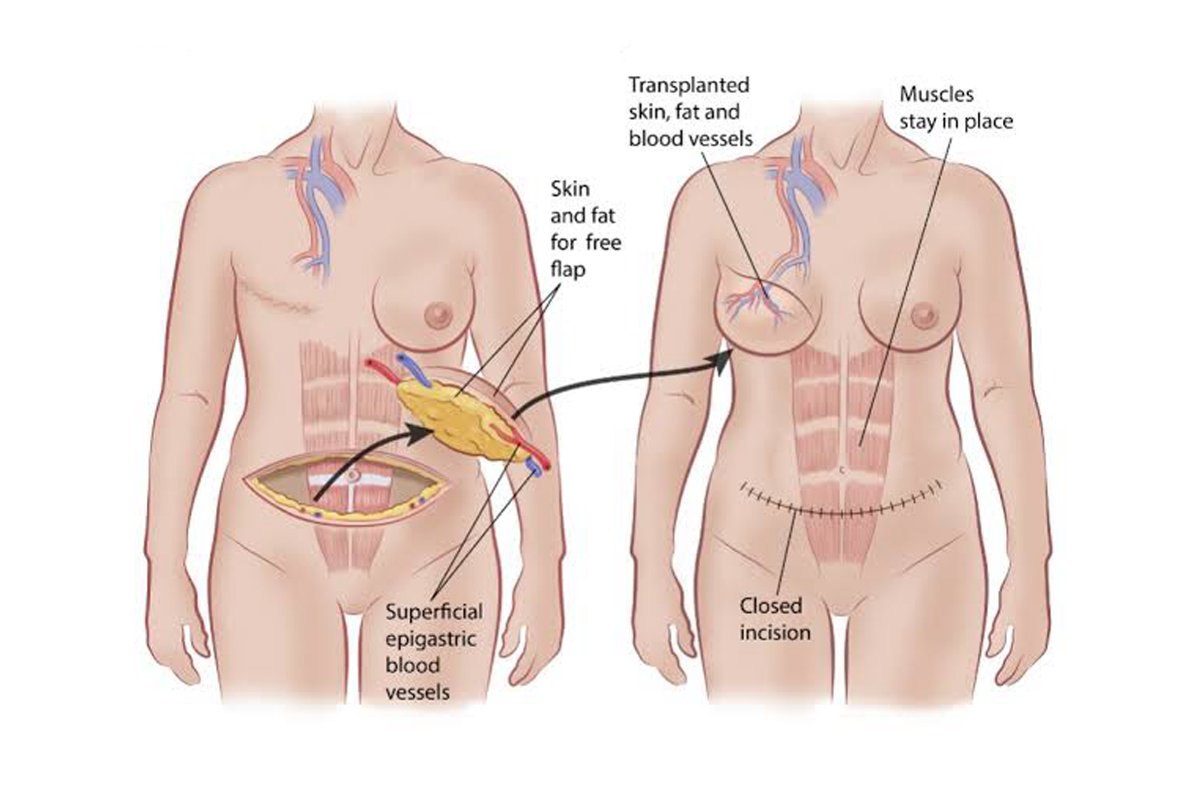 DIEP-flap-for-Breast-Reconstruction