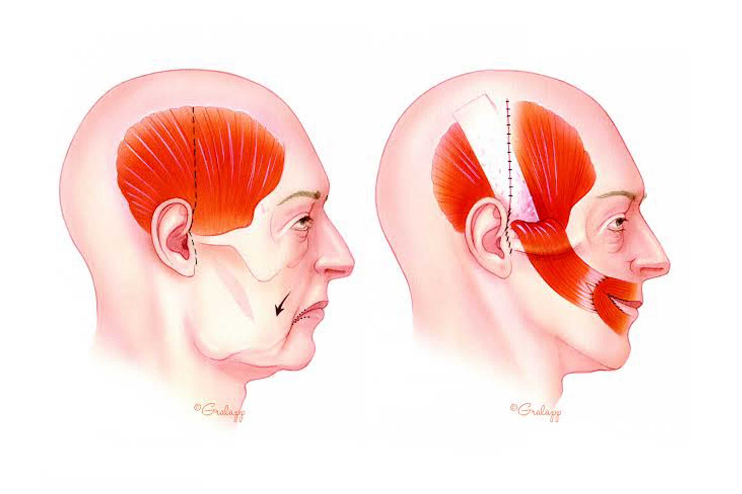 Facial-Re-animation-1
