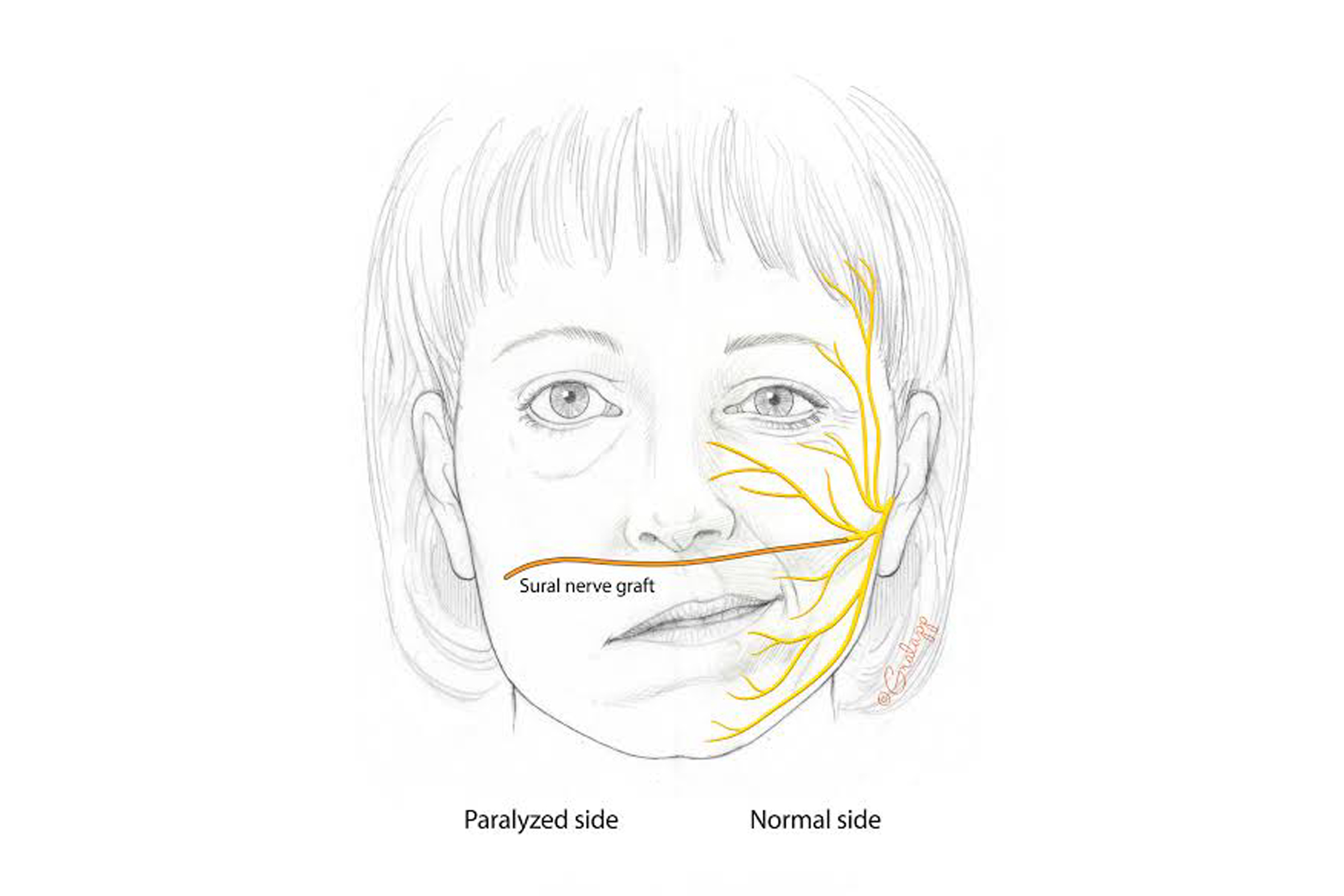 Facial-Re-animation-2