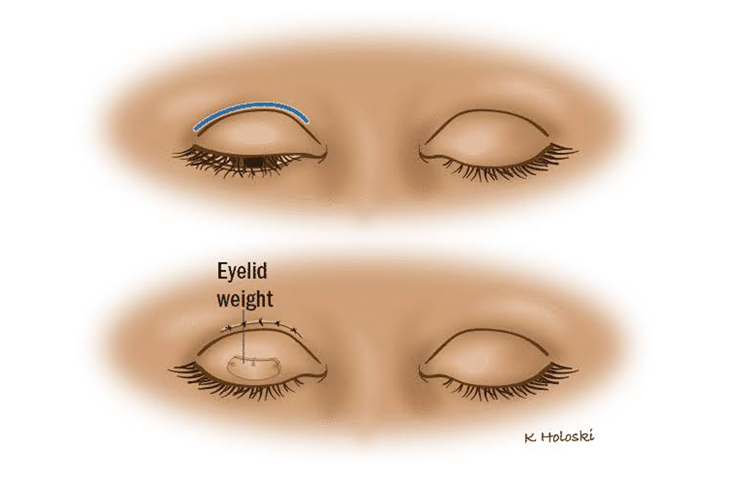 Facial-Re-animation-3