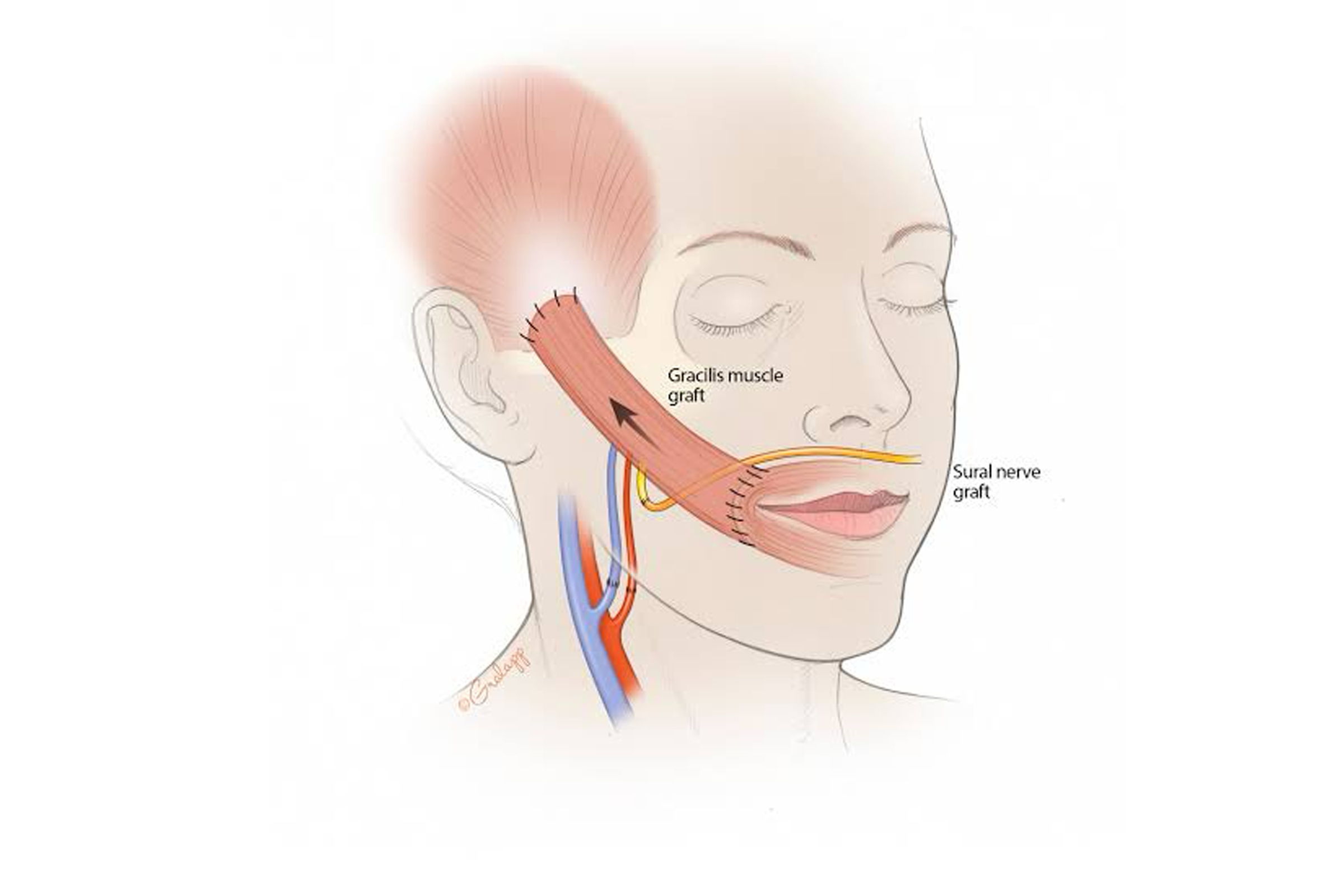 Facial-Re-animation-4