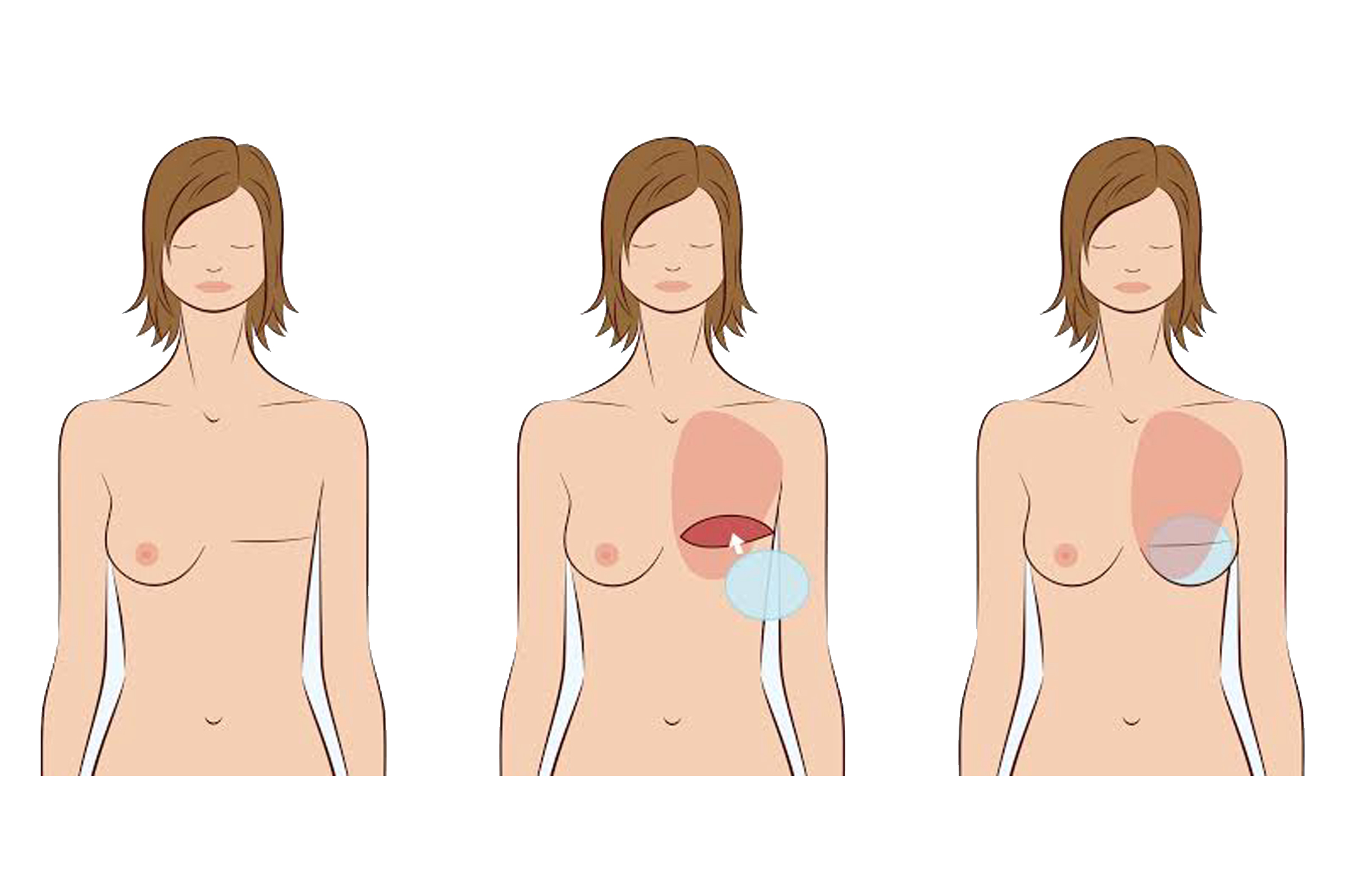 Implant-based-reconstruction