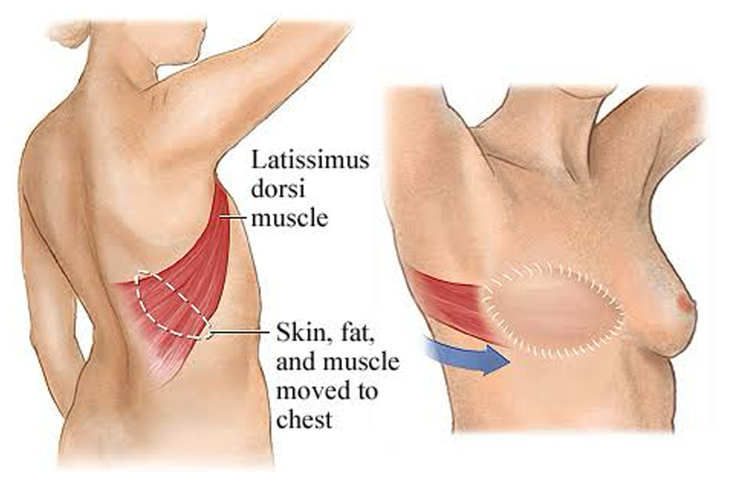 LD-flap-for-breast-reconstruction