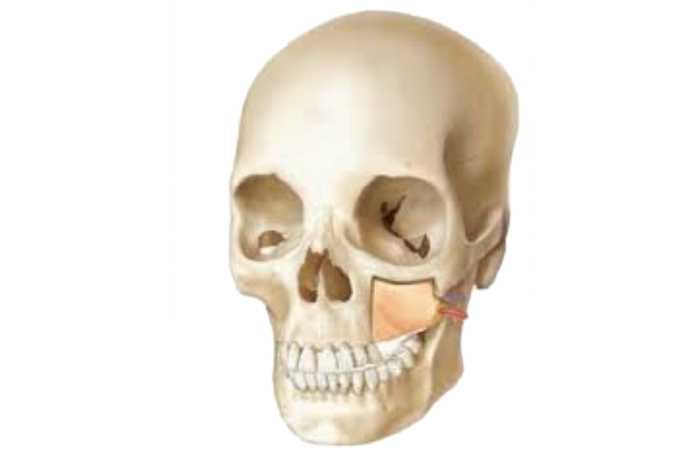 Maxilla-reconstruction-FALT
