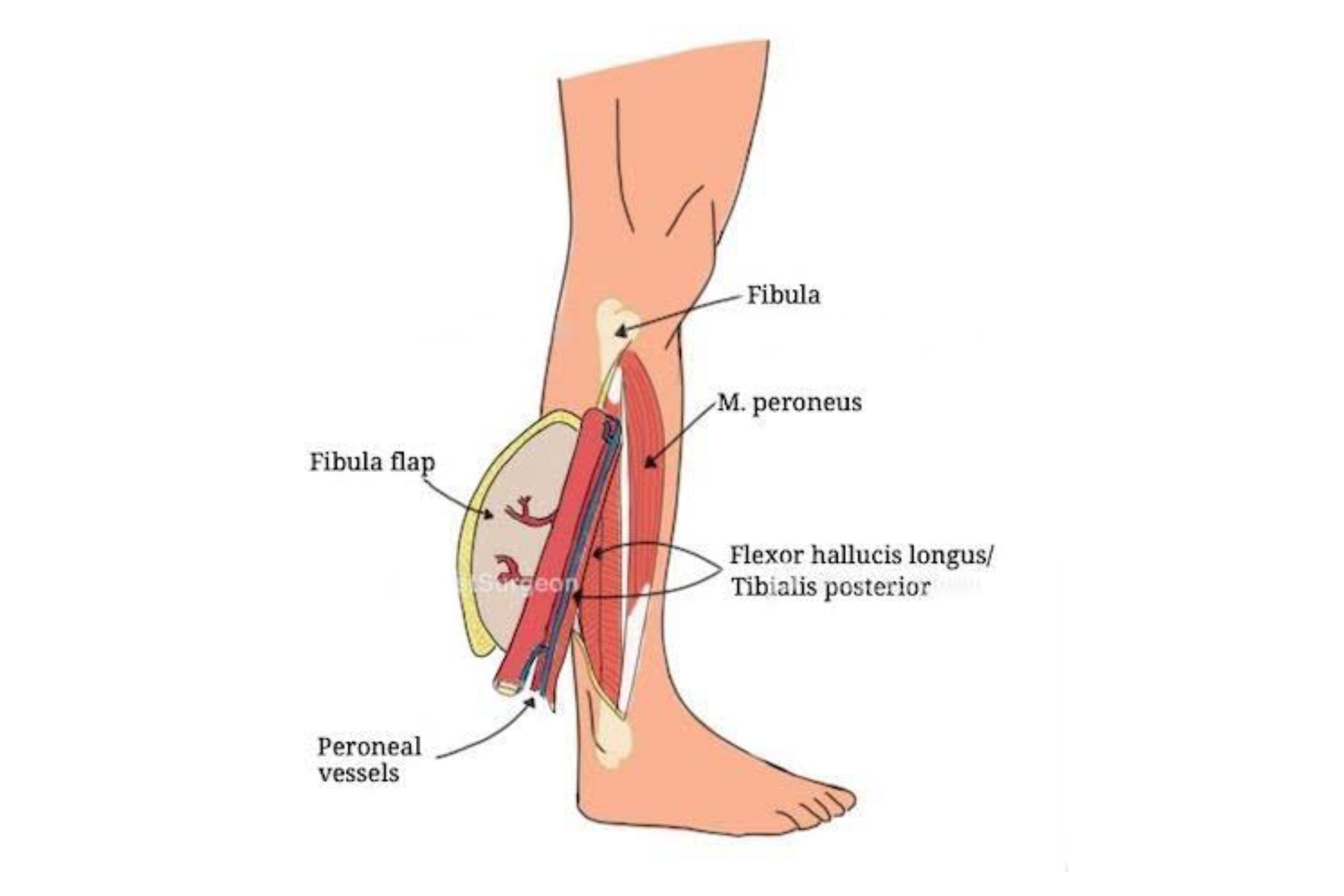 Maxilla-reconstruction-using-FFOCF