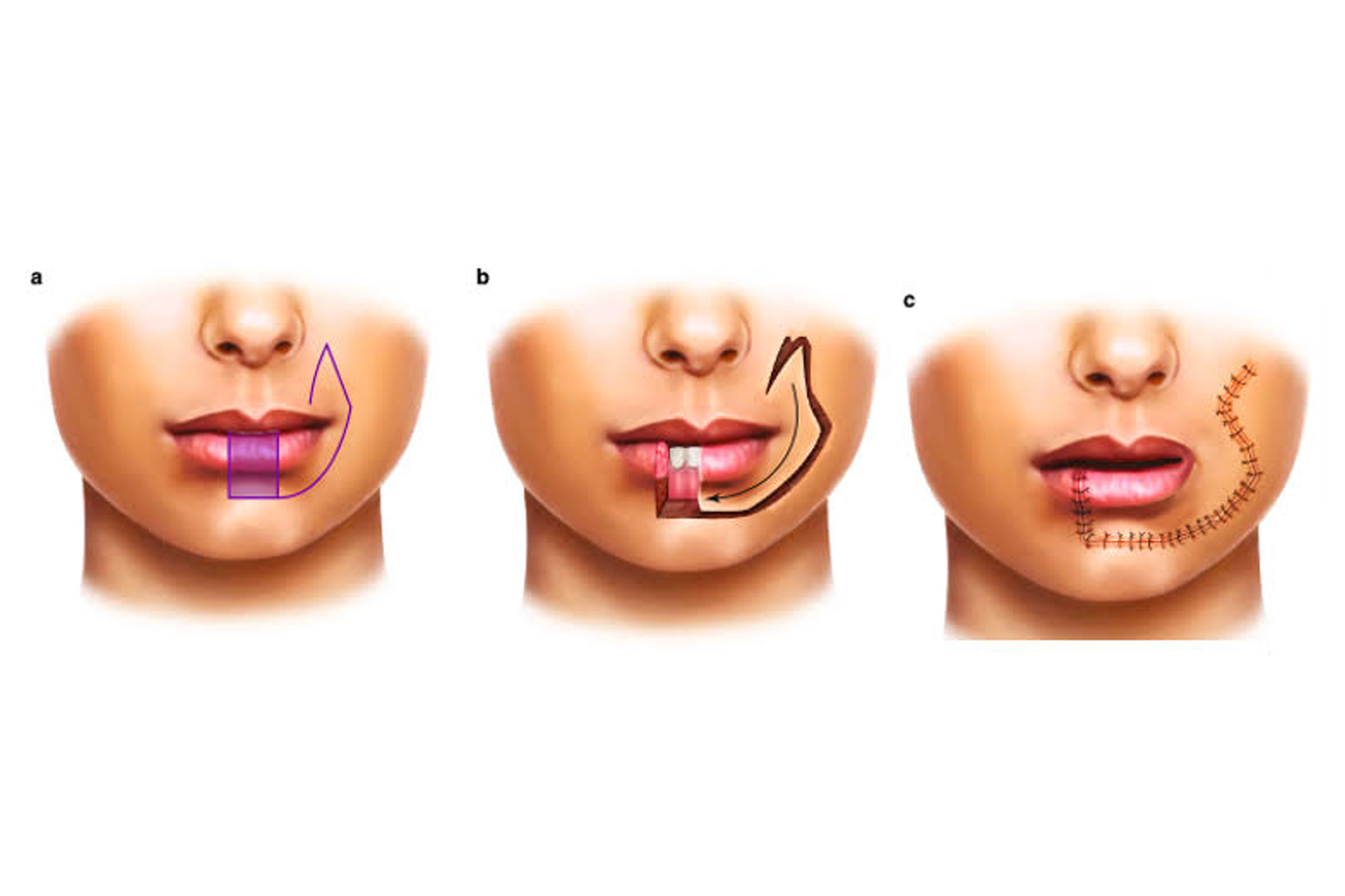 local-tissue-rearrangement-1