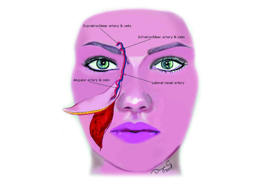 nasolabial-flap